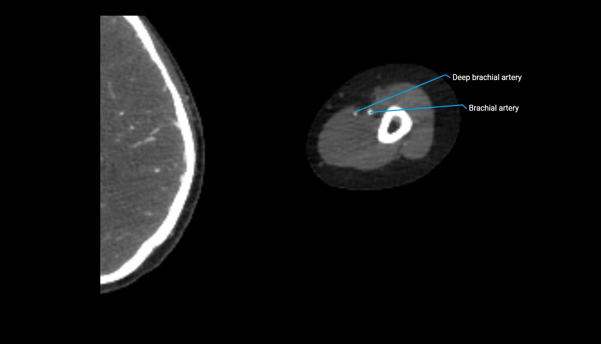 CTA upper limb axial cross sectional anatomy labelled image 239 (2).webp